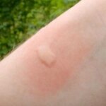 chikungunya-en-argentina:-salta-supera-los-150-casos-y-detectan-el-primero-en-catamarca