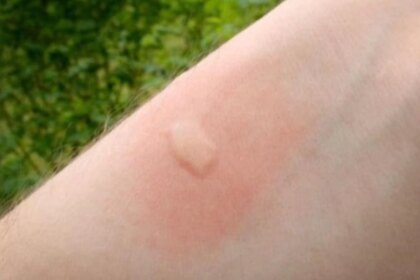 chikungunya-en-argentina:-salta-supera-los-150-casos-y-detectan-el-primero-en-catamarca
