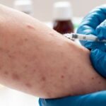 un-informe-de-instituciones-de-salud-de-michigan-advirtio-sobre-la-evolucion-clinica-del-sifilis-y-la-mutacion-de-sintomas-tradicionales