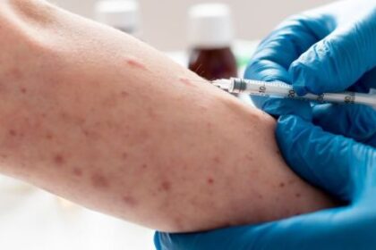 un-informe-de-instituciones-de-salud-de-michigan-advirtio-sobre-la-evolucion-clinica-del-sifilis-y-la-mutacion-de-sintomas-tradicionales