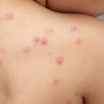 confirman-un-nuevo-caso-de-mpox-en-caba:-que-es,-como-se-contagia-y-cuales-son-los-sintomas