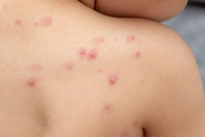confirman-un-nuevo-caso-de-mpox-en-caba:-que-es,-como-se-contagia-y-cuales-son-los-sintomas