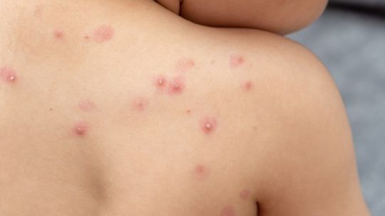 confirman-un-nuevo-caso-de-mpox-en-caba:-que-es,-como-se-contagia-y-cuales-son-los-sintomas