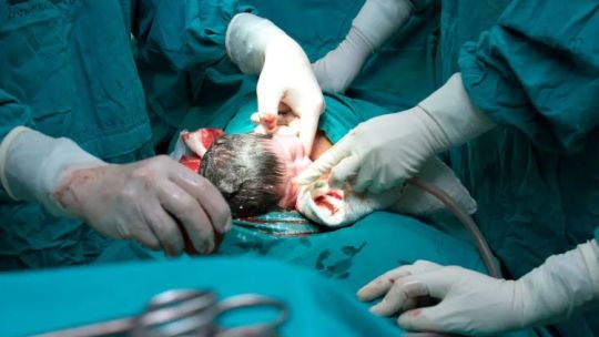 en-argentina-4-de-cada-10-bebes-nacen-por-cesarea,-el-triple-de-lo-recomendado