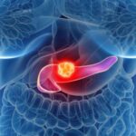 cancer-de-pancreas:-una-pildora-duplica-la-supervivencia-de-pacientes-graves