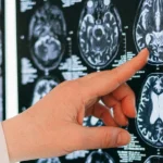 advierten-que-no-controlar-los-niveles-de-una-vitamina-esencial-para-el-cuerpo-podria-alterar-la-memoria