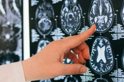 advierten-que-no-controlar-los-niveles-de-una-vitamina-esencial-para-el-cuerpo-podria-alterar-la-memoria