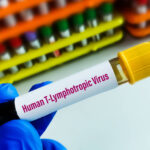 virus-htlv-1-causa-sindrome-inflamatoria-em-assintomaticos,-aponta-estudo