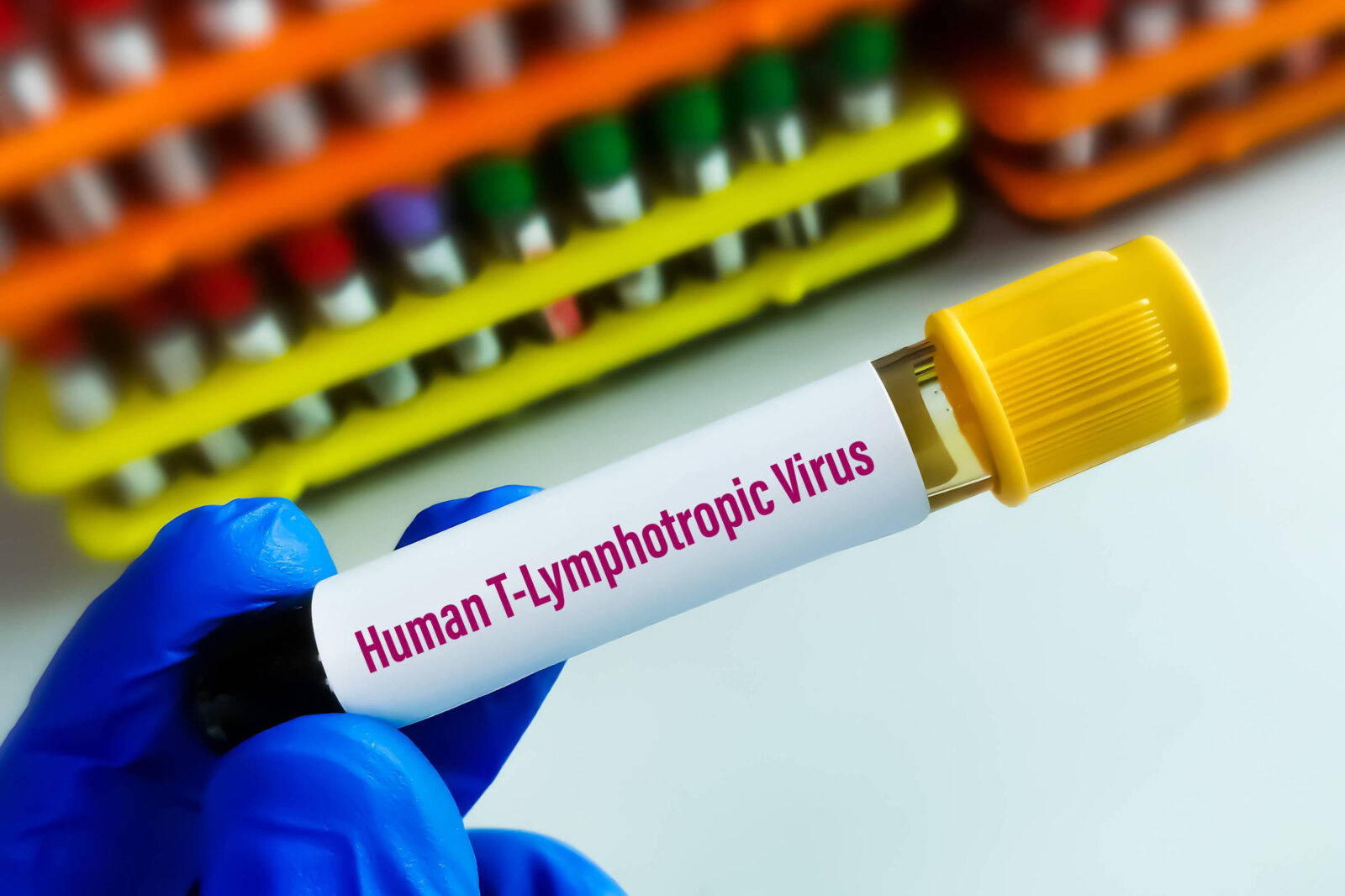 virus-htlv-1-causa-sindrome-inflamatoria-em-assintomaticos,-aponta-estudo