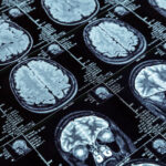pesquisadores-desenvolvem-metodo-para-prever-alzheimer-antes-dos-primeiros-sinais