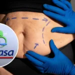 bono-pad:-fonasa-cubre-cirugias-bariatricas-y-abdomen-flacido