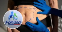 bono-pad:-fonasa-cubre-cirugias-bariatricas-y-abdomen-flacido