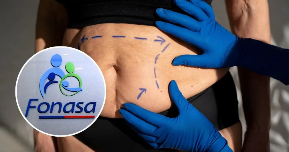 bono-pad:-fonasa-cubre-cirugias-bariatricas-y-abdomen-flacido