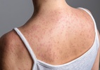 nova-york-declara-emergencia-apos-108-casos-de-sarampo