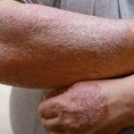 por-el-dia-de-la-psoriasis-realizaran-jornada-de-apoyo