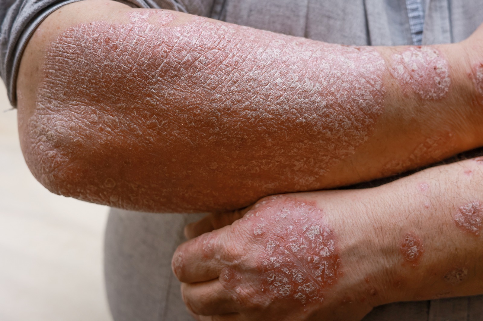 por-el-dia-de-la-psoriasis-realizaran-jornada-de-apoyo