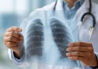 anvisa-aprova-‘bomba-inteligente’-contra-cancer-de-pulmao-avancado