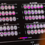 mudanca-de-habitos-ajuda-a-diminuir-probabilidade-de-alzheimer,-mesmo-com-risco-genetico