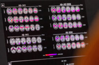 mudanca-de-habitos-ajuda-a-diminuir-probabilidade-de-alzheimer,-mesmo-com-risco-genetico