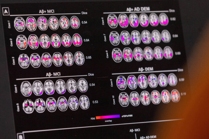 mudanca-de-habitos-ajuda-a-diminuir-probabilidade-de-alzheimer,-mesmo-com-risco-genetico