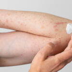invitan-a-gran-encuentro-para-personas-con-psoriasis