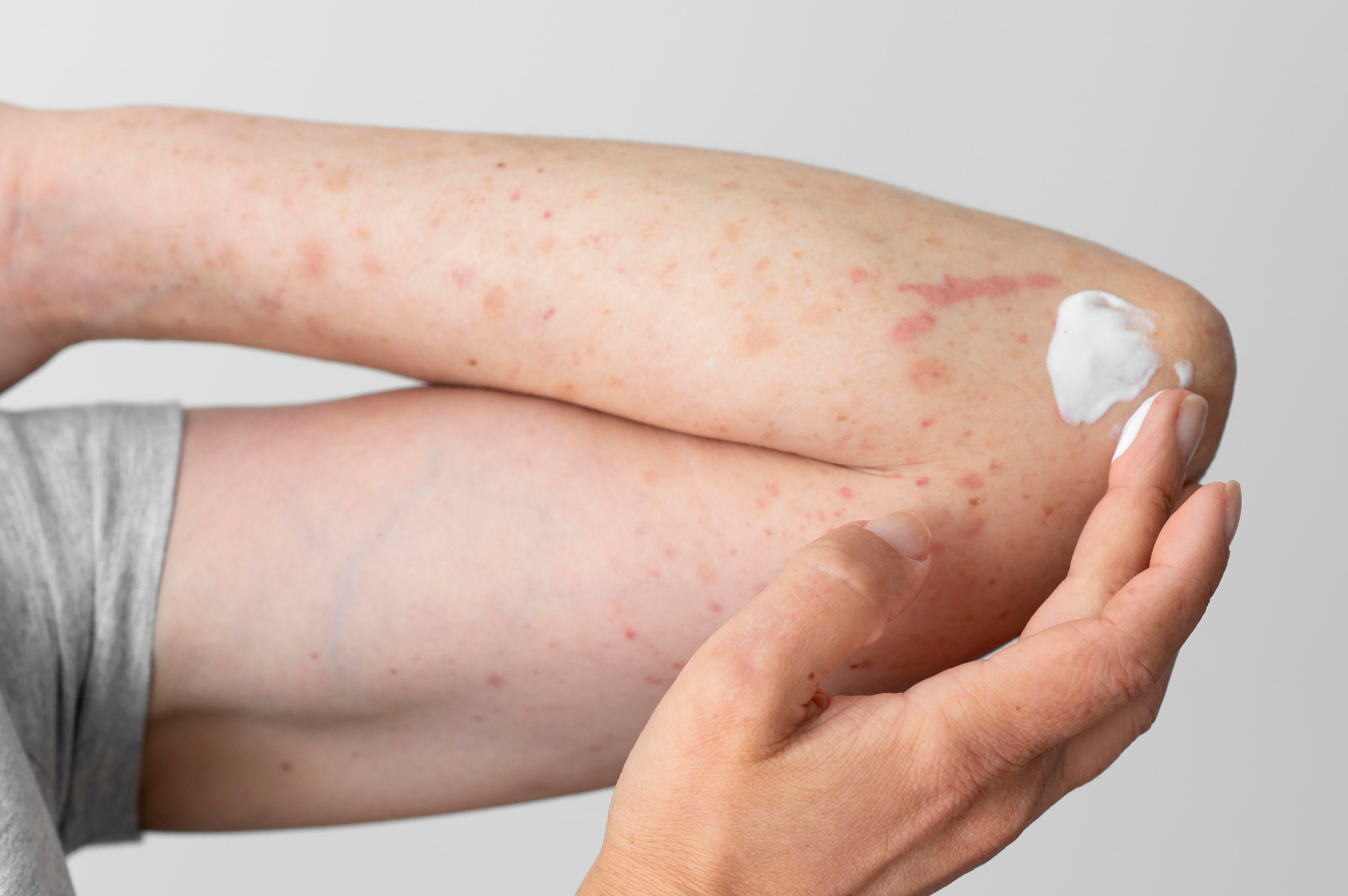invitan-a-gran-encuentro-para-personas-con-psoriasis